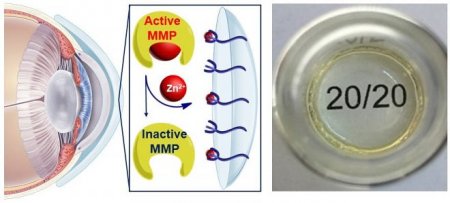 Гидрогелевые линзы помогут победить неизлечимое заболевание глаз