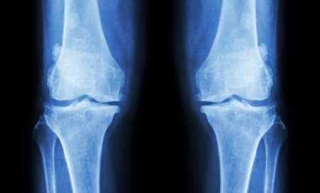 Почему у вегетарианцев хрупкие кости?