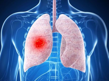 Почему рак легких возникает у некурящих людей и каким он бывает?